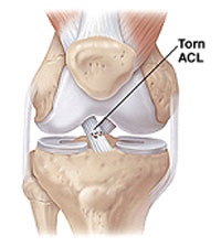 torn-ACL